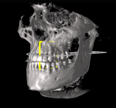 Tomografia komputerowa CBCT RTG 3D w Cime Tychy