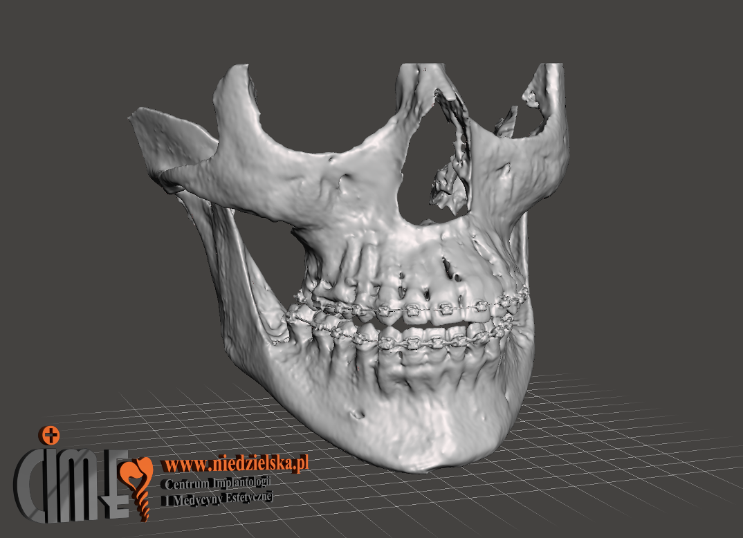 Druk modelu 3D całej czaszki pacjenta w Cime Tychy