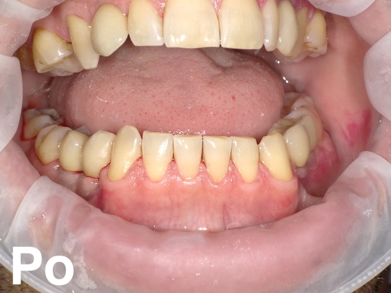 Zabieg higienizacji zębów efekt po higienizacji