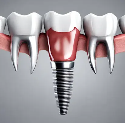 Implantacja implantów zębowych w Cime Tychy